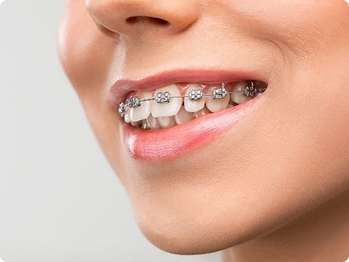 Braces and Aligners