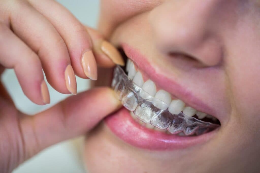 Braces treatment