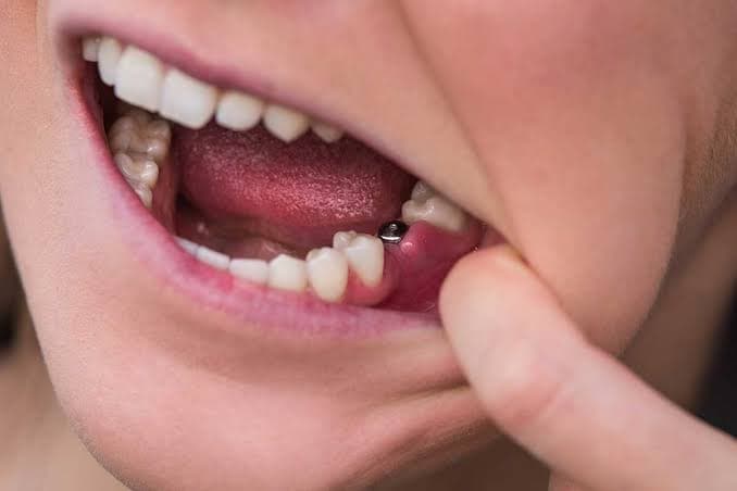 Dental implant supported teeth