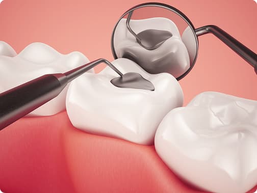 Dental Filling