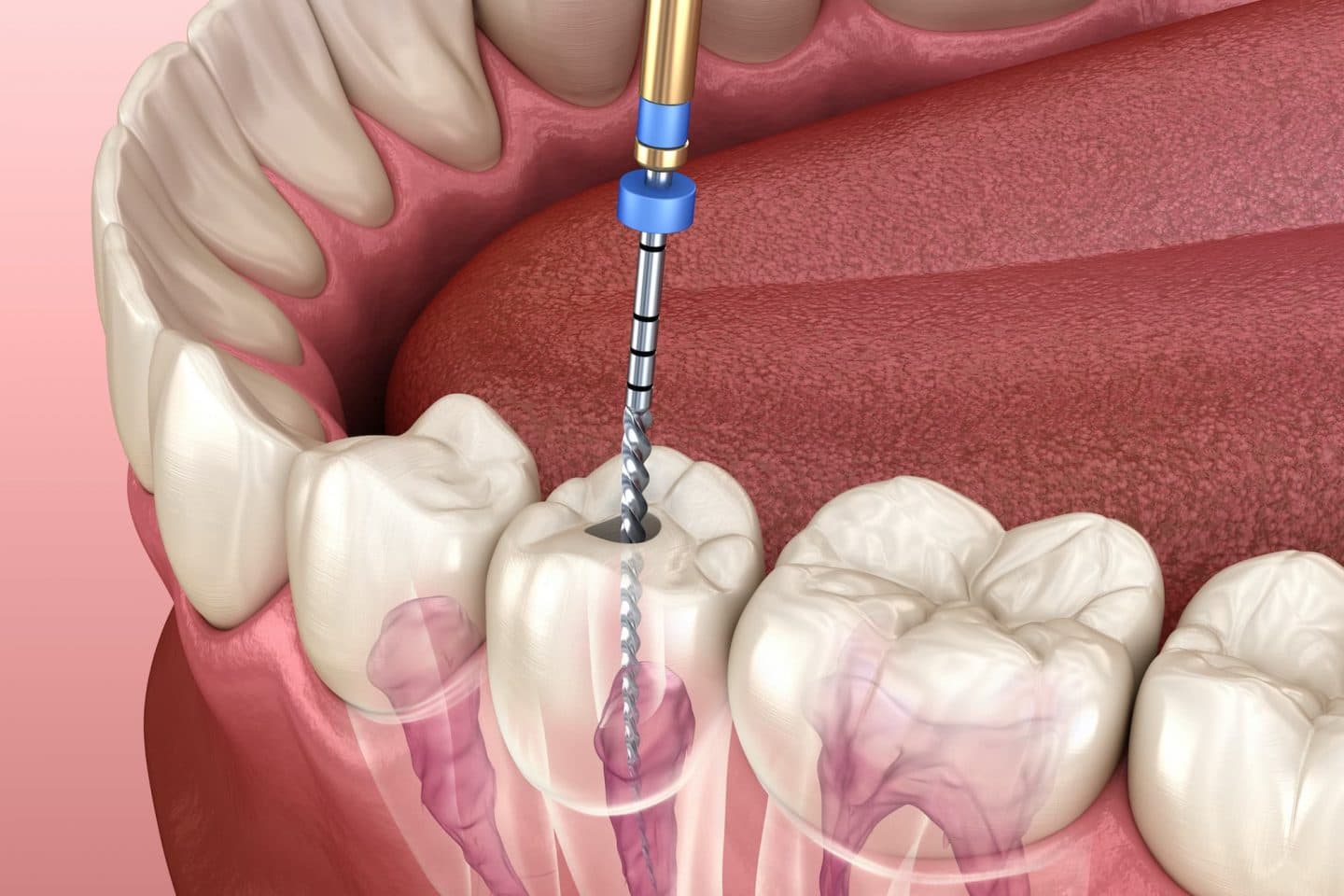 Root Canal Treatment(RCT)