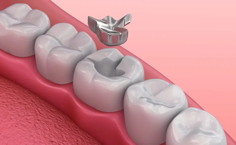 Dental filling treatment