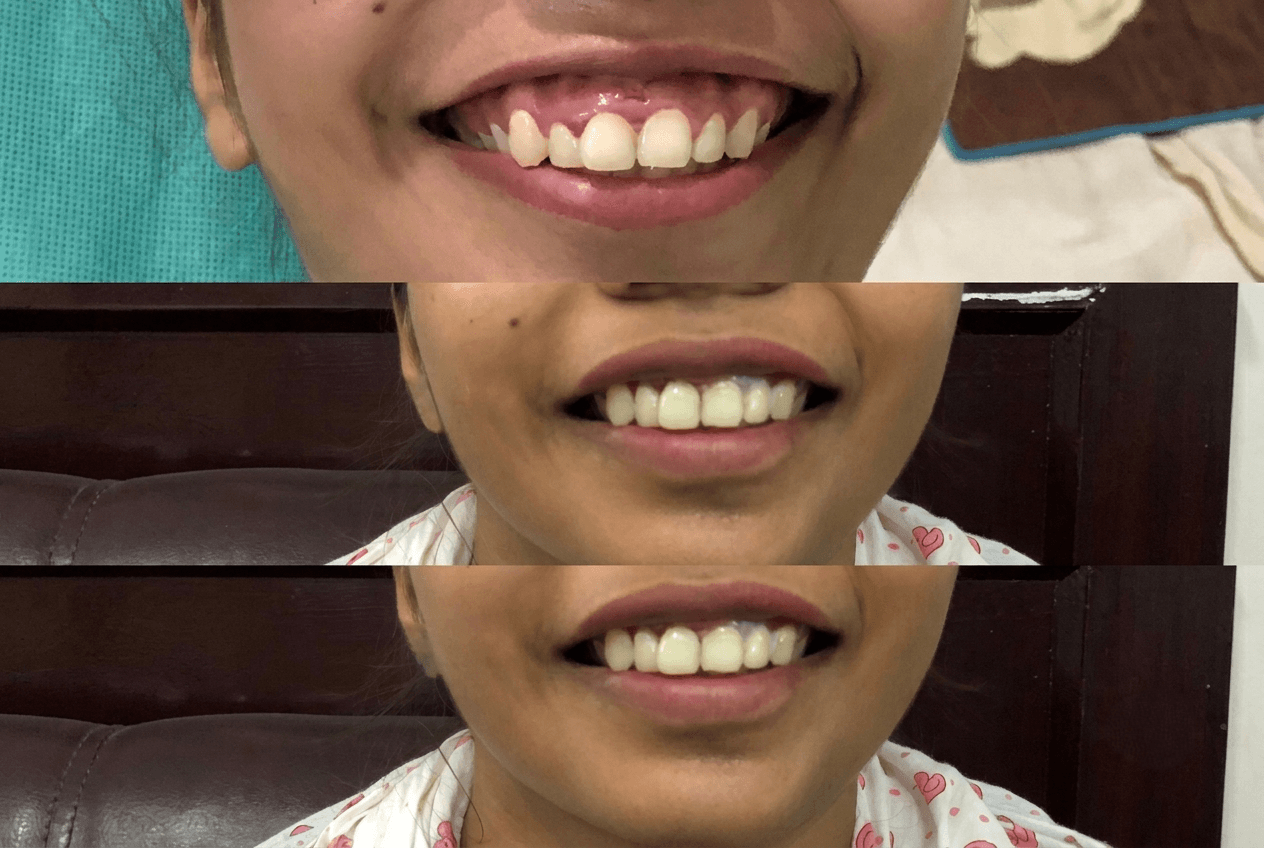 Smile Designing & Cosmetic Dentistry